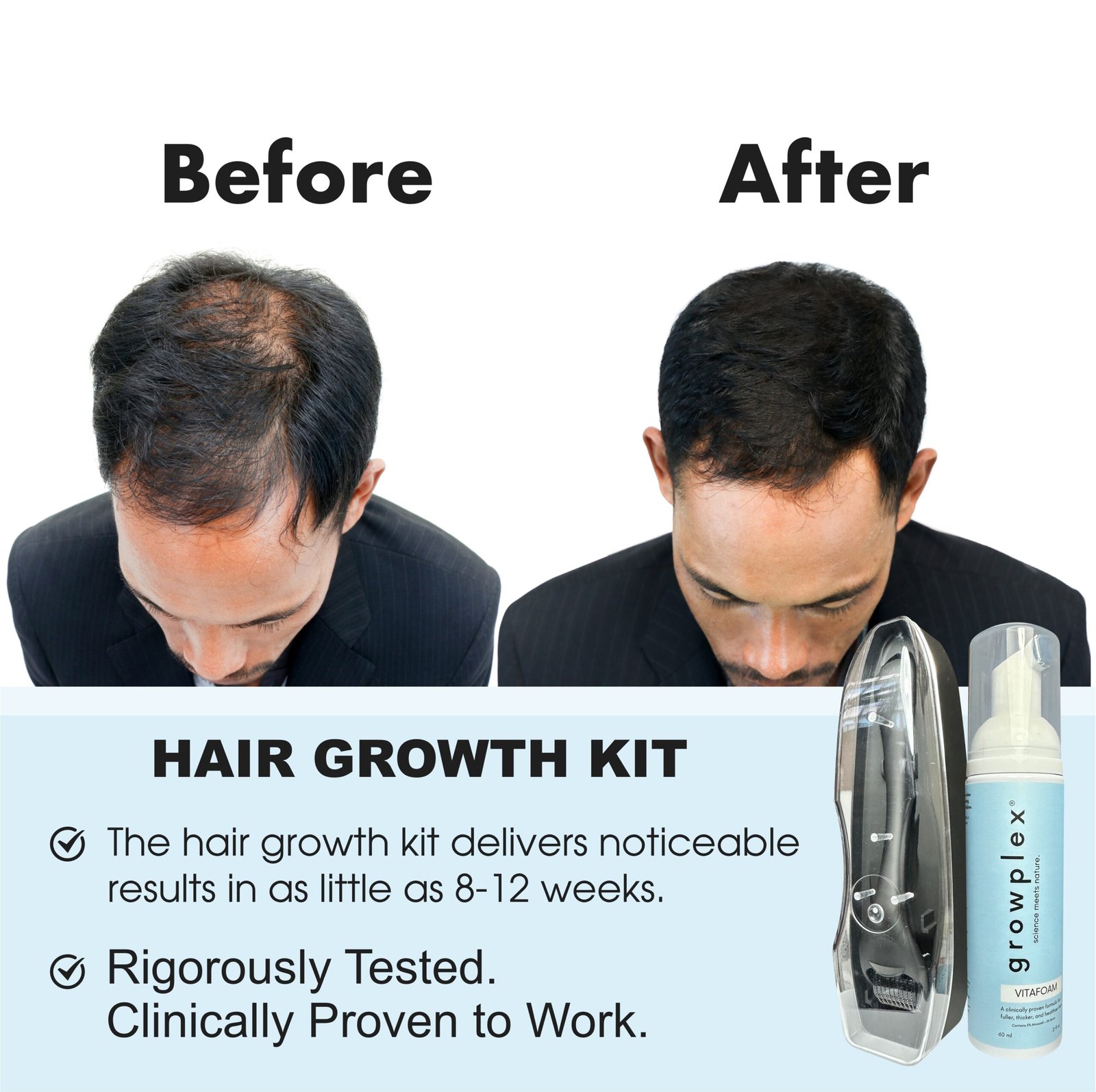 VitaForm & Scalp Roller Hair Growth Kit