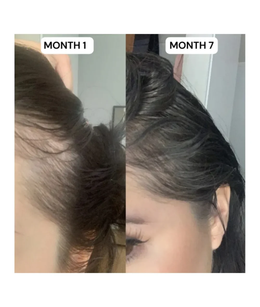 Hair Growth Kit: Advanced 2-Step System for Reclaiming Your Hairline