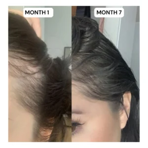 Hair Growth Kit: Advanced 2-Step System for Reclaiming Your Hairline