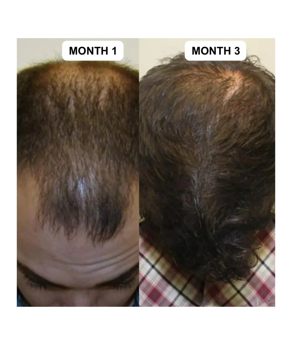 Hair Growth Kit: Advanced 2-Step System for Reclaiming Your Hairline