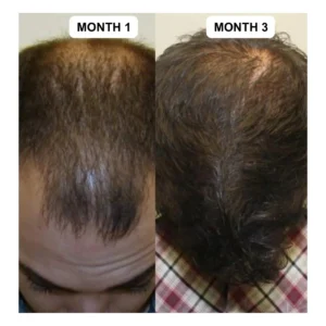 Hair Growth Kit: Advanced 2-Step System for Reclaiming Your Hairline