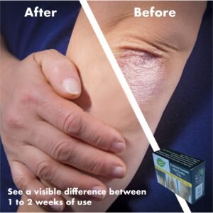 Eczema & Psoriasis Herbal Soap