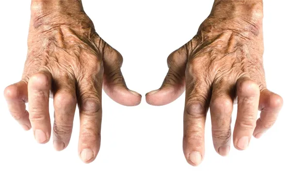 Rheumatoid Arthritis Explained: Symptoms, Causes & Management for Better Living Rheumatoid Arthritis Explained: Symptoms, Causes & Management for Better Living